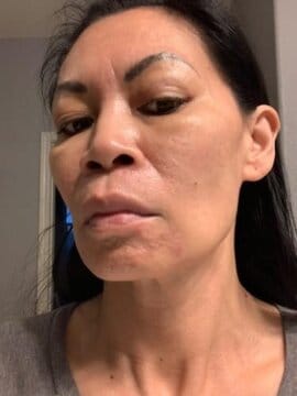 Customer photo review of BeautyPro 2.0 - High Frequency Wand