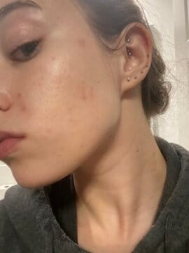 Customer photo review of BeautyPro 2.0 - High Frequency Wand
