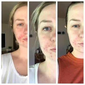 Customer photo review of BeautyPro 2.0 - High Frequency Wand
