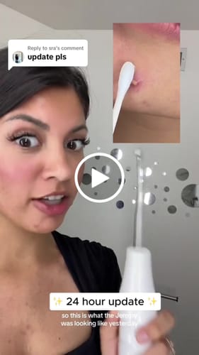 Customer video review of BeautyPro 2.0 - High Frequency Wand