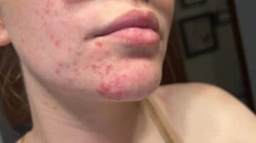 Customer photo review of BeautyPro 2.0 - High Frequency Wand