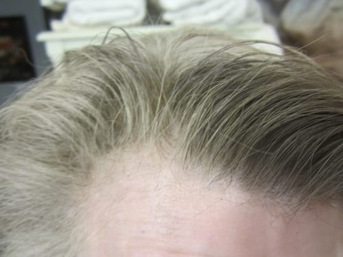 Customer photo review of 12.5% Minoxidil Extra Strength Topical Solution USP for Men.