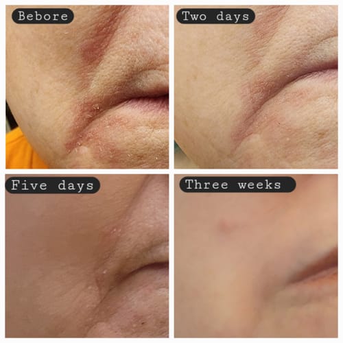 Customer photo review of Hypochlorous Acid Spray for Skin & Face | Cleansing Topical Spray