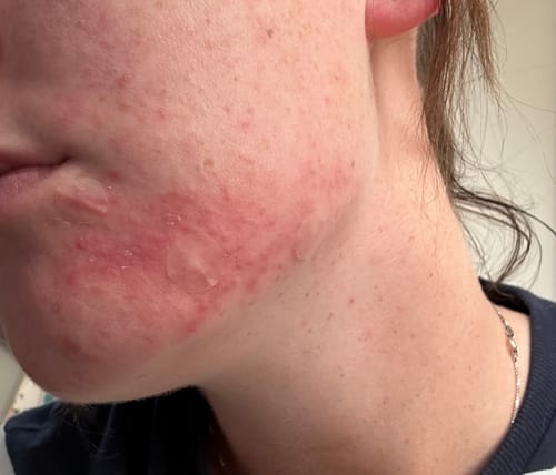 Customer photo review of Advanced Acne Program™