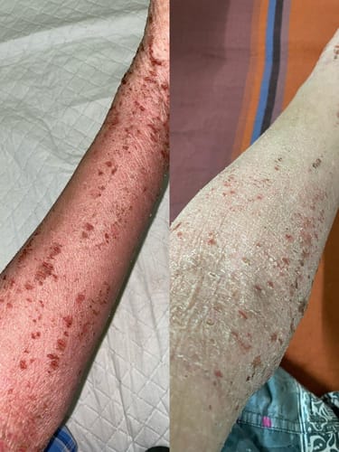Customer photo review of Eczema Scratch Mitten
