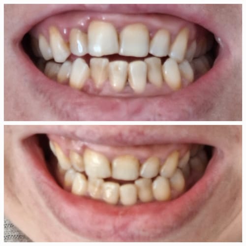 Customer photo review of Teeth Whitening Strips