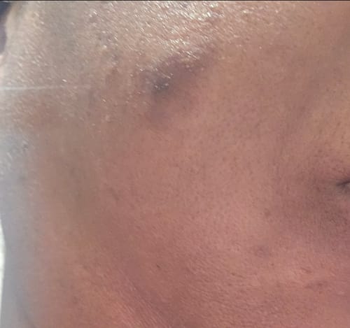Lavonia M. review of Dark Spot Micro Dart Patches (with Turmeric) image 1 out of 3