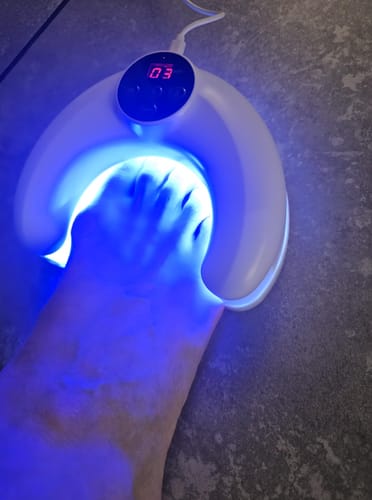 Customer photo review of Nail Fungus Laser Removal