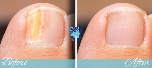 Customer photo review of Nail Fungus Laser Removal