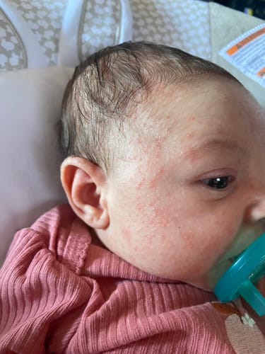 Customer photo review of All Over Ointment Eczema Treatment