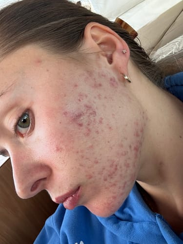 Customer photo review of Advanced Acne Program™