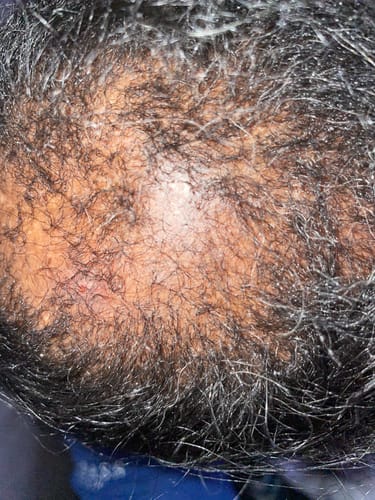 Customer photo review of 3 - Step ReGrowth Kit (Combo)