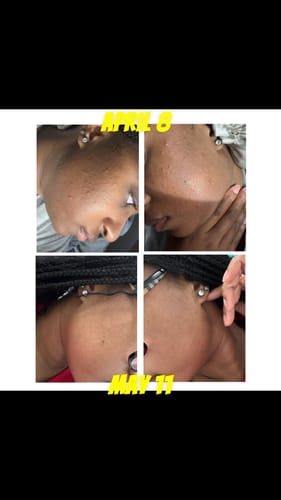 Customer photo review of LIMITED EDITION: Jolie’s Mini Full Body & Face Brightening Kit/ Acne Kit