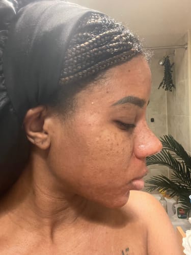 Customer photo review of MelanX Chemical Peel | Home Use Application