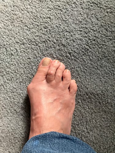 Customer photo review of Treatmedy™ Bunion Fix - Natural At-Home Bunion Relief