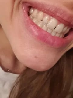 Customer photo review of 🏆Official Store | DIYSTAR™ Moldable Dentures(Brand new upgrade)