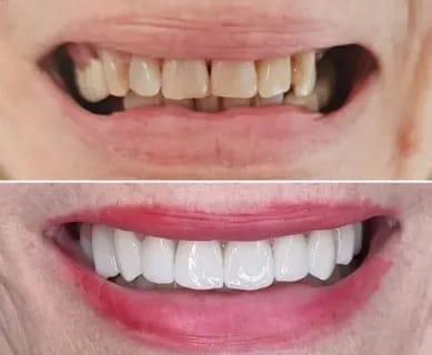Customer photo review of 🏆Official Store | DIYSTAR™ Moldable Dentures(Brand new upgrade)