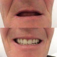 Customer photo review of 🏆Official Store | DIYSTAR™ Moldable Dentures(Brand new upgrade)