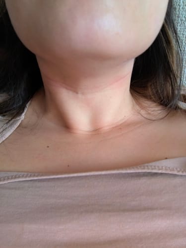 Customer photo review of Sereni Pikkelysömör és Ekcéma Krém