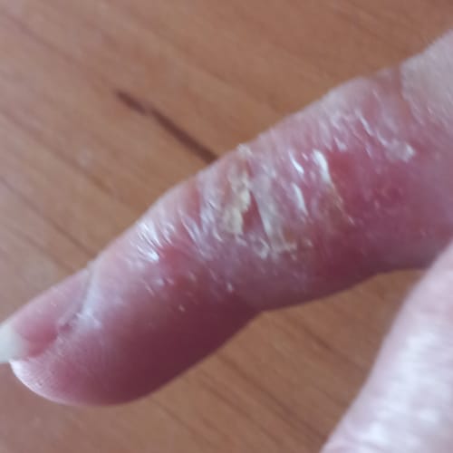 Customer photo review of Sereni Pikkelysömör és Ekcéma Krém