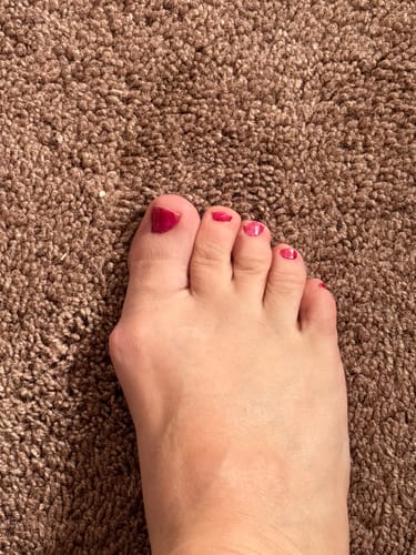 Customer photo review of Treatmedy™ Bunion Fix - Natural At-Home Bunion Relief