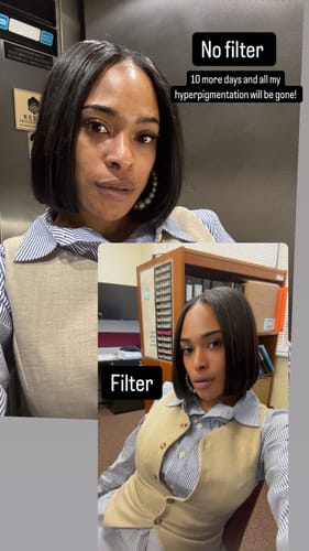 Customer photo review of BIGGER EDITION: Jolie’s Full Body & Face Brightening / Acne Kit