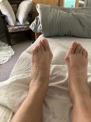 Customer photo review of Treatmedy™ Bunion Fix - Natural At-Home Bunion Relief