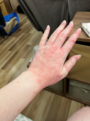 Customer photo review of SERENI Pikkelysömör és Ekcéma Krém