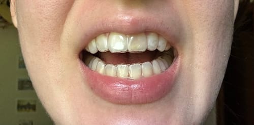 Customer photo review of Upper and Lower Retainers Set