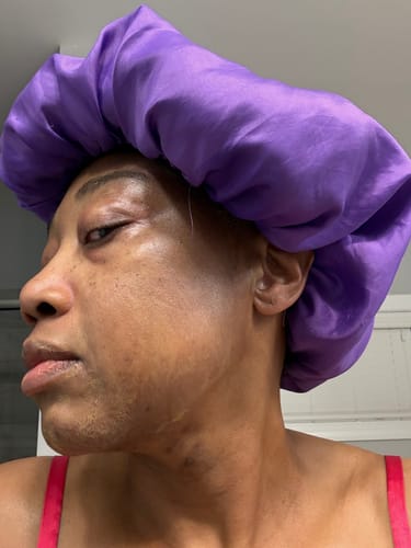 Customer photo review of MelanX Chemical Peel | Home Use Application