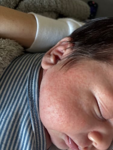 Customer photo review of All Over Ointment Eczema Treatment