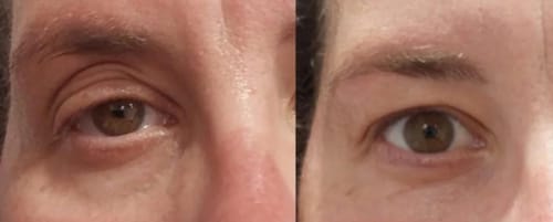 Customer photo review of SYNERGY EYE