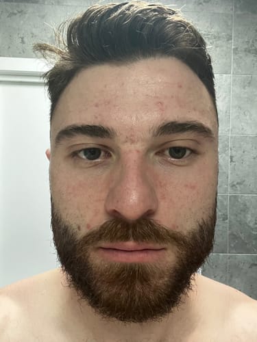 Customer photo review of Advanced Acne Program™