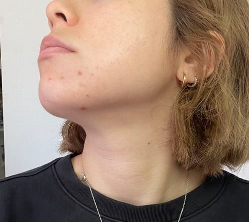 Customer photo review of Intermediate Acne Program™