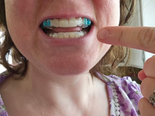 Customer photo review of Sleep Apnea Sleep Appliance, Includes Connectors $65 value