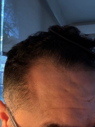 Customer photo review of 12.5% Minoxidil Extra Strength Topical Solution USP for Men.