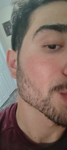 Customer photo review of Derma Stamp Micro Needling Skin Tool