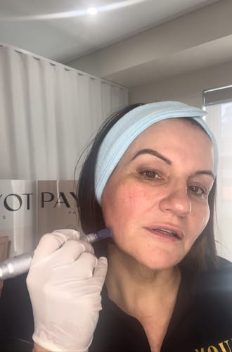 Customer photo review of Dr. Pen Ultima A6 Professional Plus