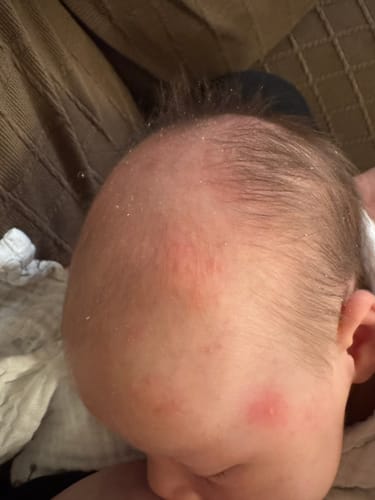 Customer photo review of All Over Ointment Eczema Treatment