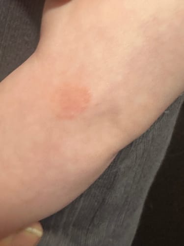 Customer photo review of All Over Ointment Eczema Treatment