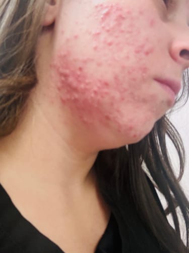 Customer photo review of The Complete Acne System for Women