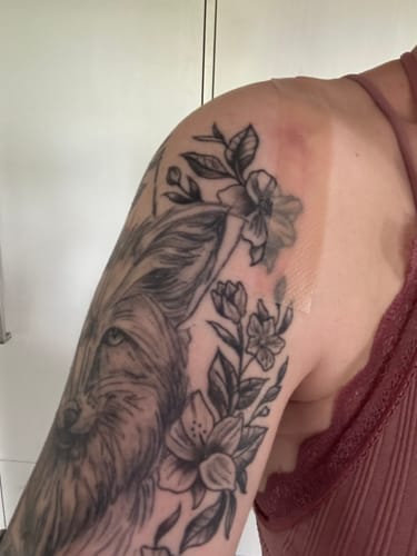 Customer photo review of ScarRelief™ | Silikon-Narbenpflaster
