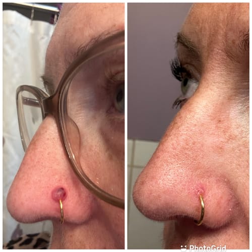 Customer photo review of Keloid Bump Shrinking Duo