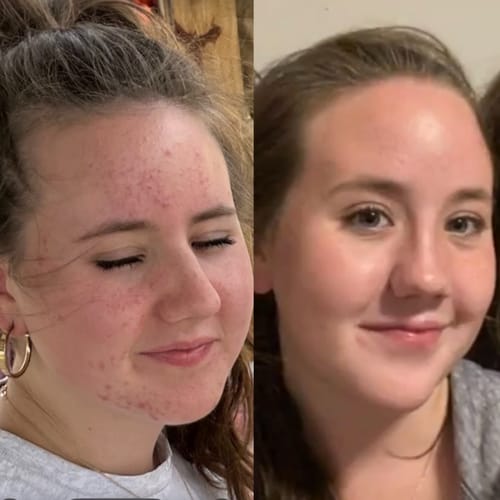 Customer photo review of Kill Acne & Redness Ritual