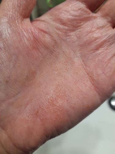 Customer photo review of SERENI Pikkelysömör és Ekcéma Krém