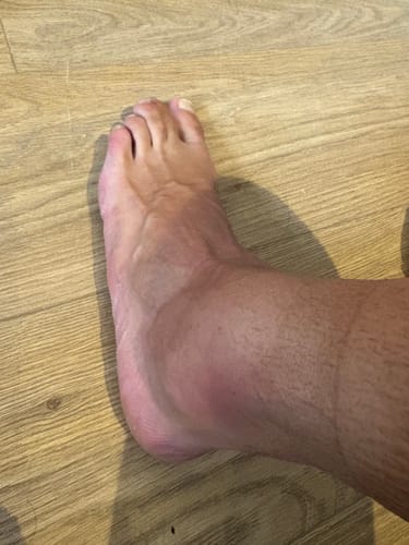 Julian G. review of Pair of Ankle Compression Support Sleeves For Achilles Tendon and Ankle Sprains image 1 out of 2