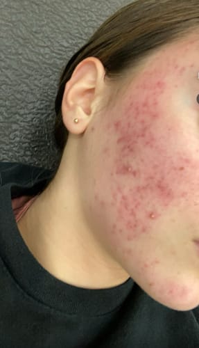 Customer photo review of The Complete Acne Killer System 2.0