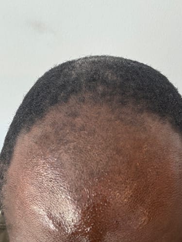 Customer photo review of Four Bottles of Rennora Hair Growth Serum