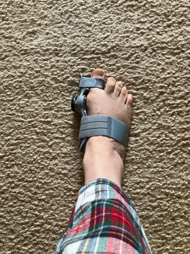 Customer photo review of Treatmedy™ Bunion Fix - Natural At-Home Bunion Relief