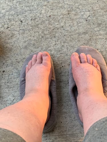 Customer photo review of Beltwell® - Fragrance-Free Non-Greasy Anti-Itch Lotion For Swollen Legs